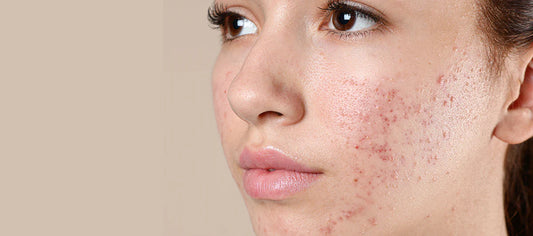 Oily Skin Got You Down? Fight Shine & Breakouts!